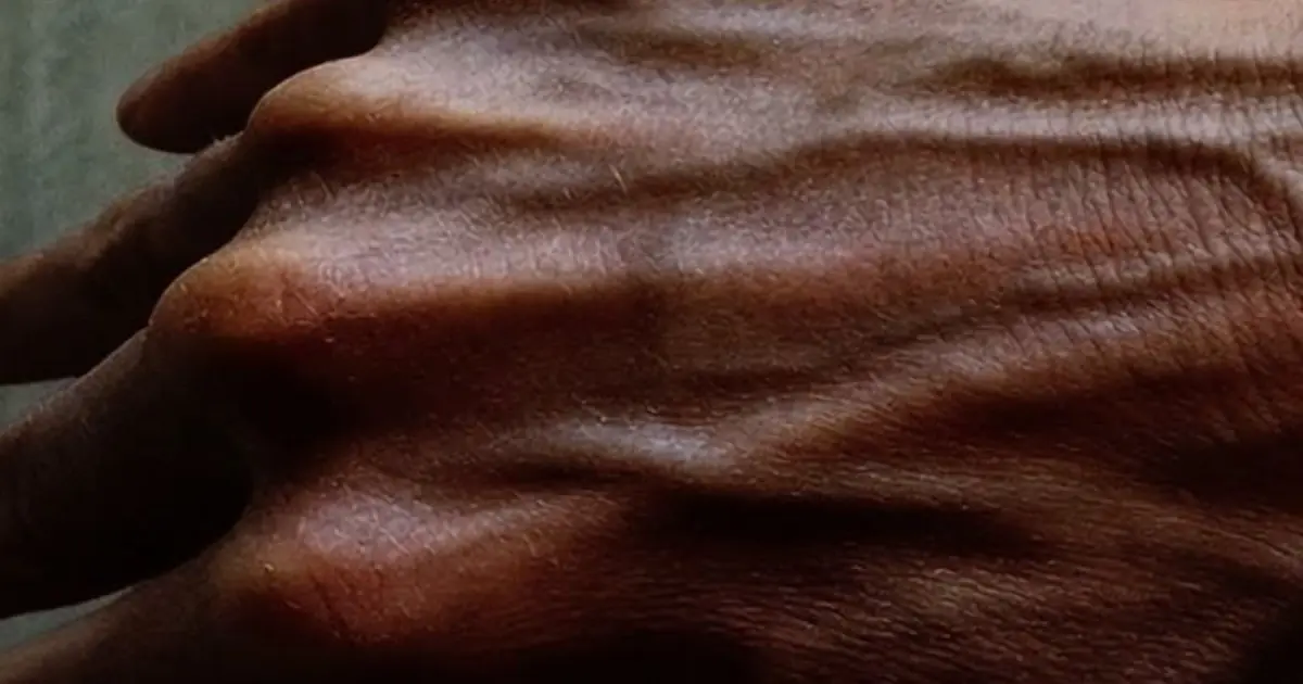 Why Are the Veins in Your Hands Suddenly More Visible? Experts Explain