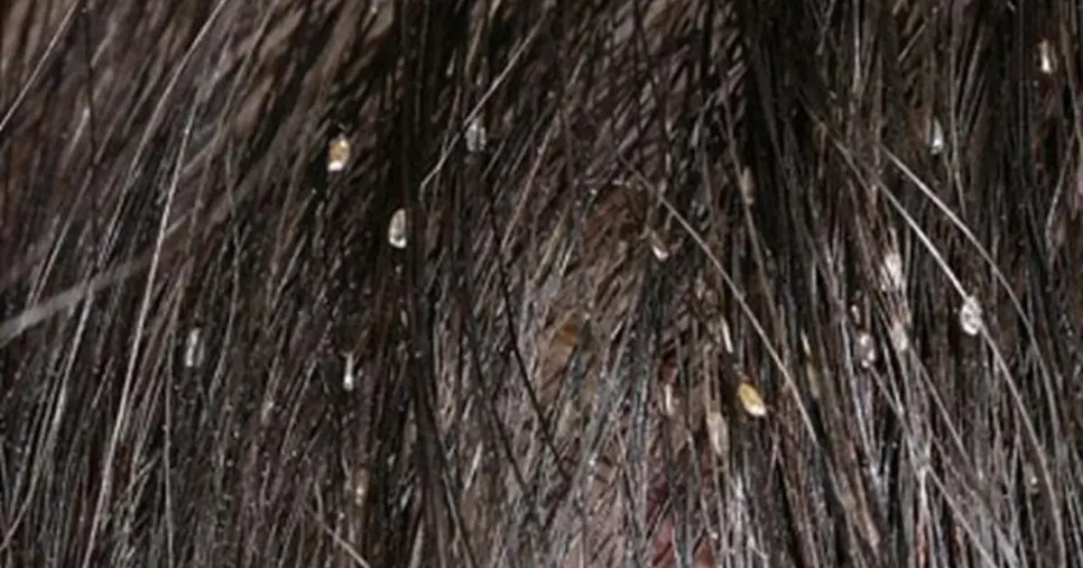 My Friend Found This Bug in Their Hair - Can Anyone Tell Us What It Is?