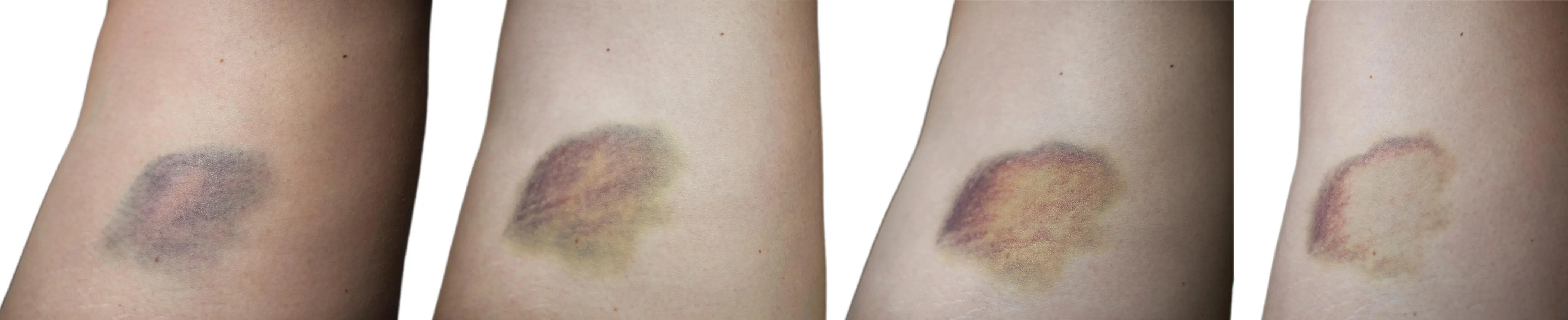 Unexpected Bruises? What Your Body Could Be Trying to Tell You