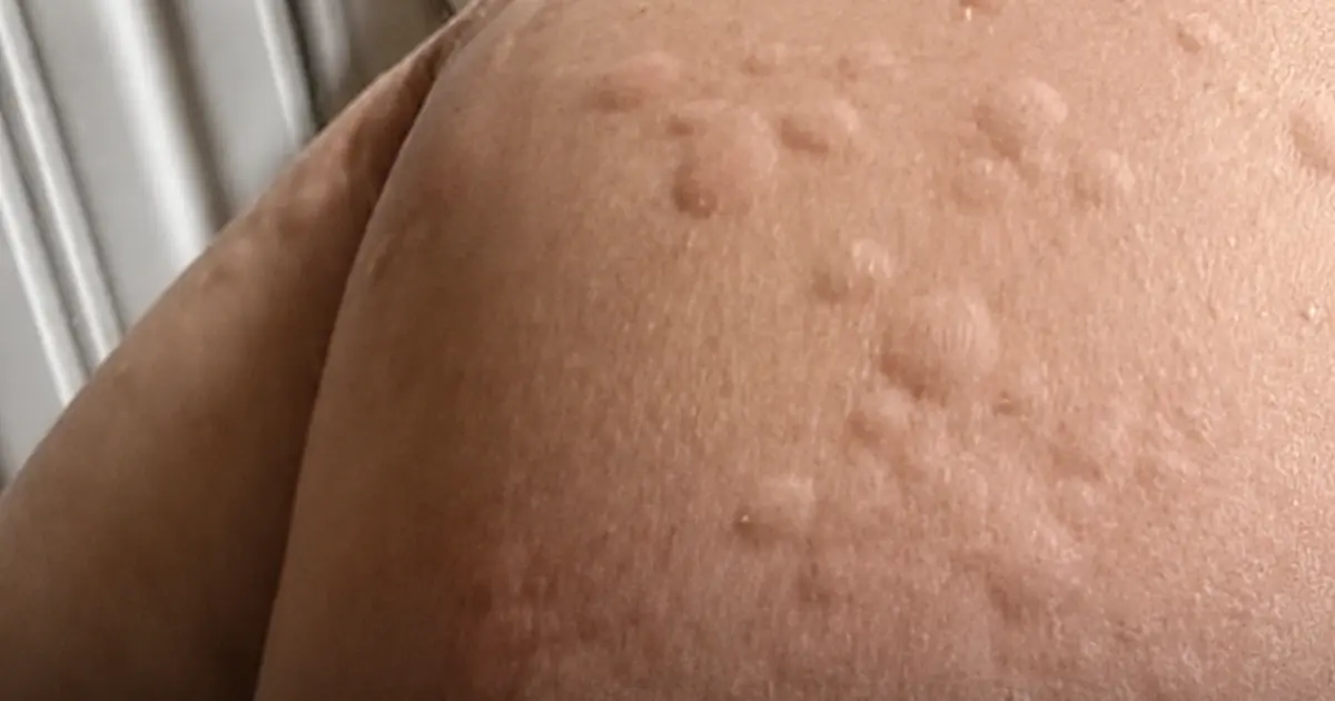 It Started as an Itch — Then the Rash Kept Spreading for Months