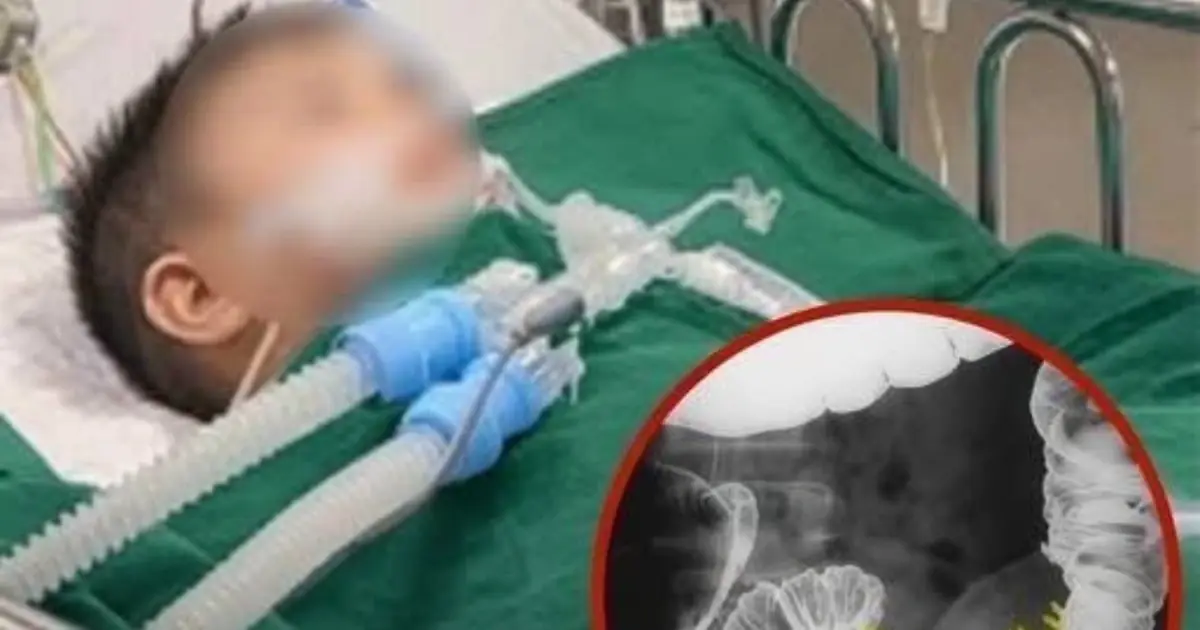 Child Diagnosed With Colon Cancer: Why Experts Say Diet Is Only One Piece of the Puzzle
