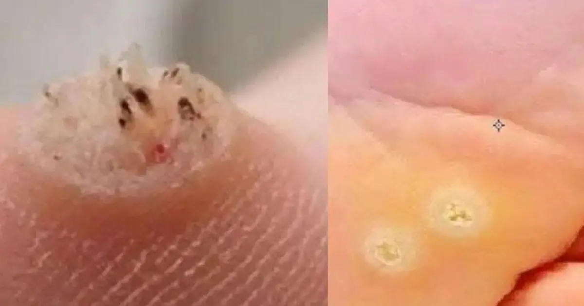 6 Types of Warts (Signs, Symptoms, Home Remedies, and Treatment)