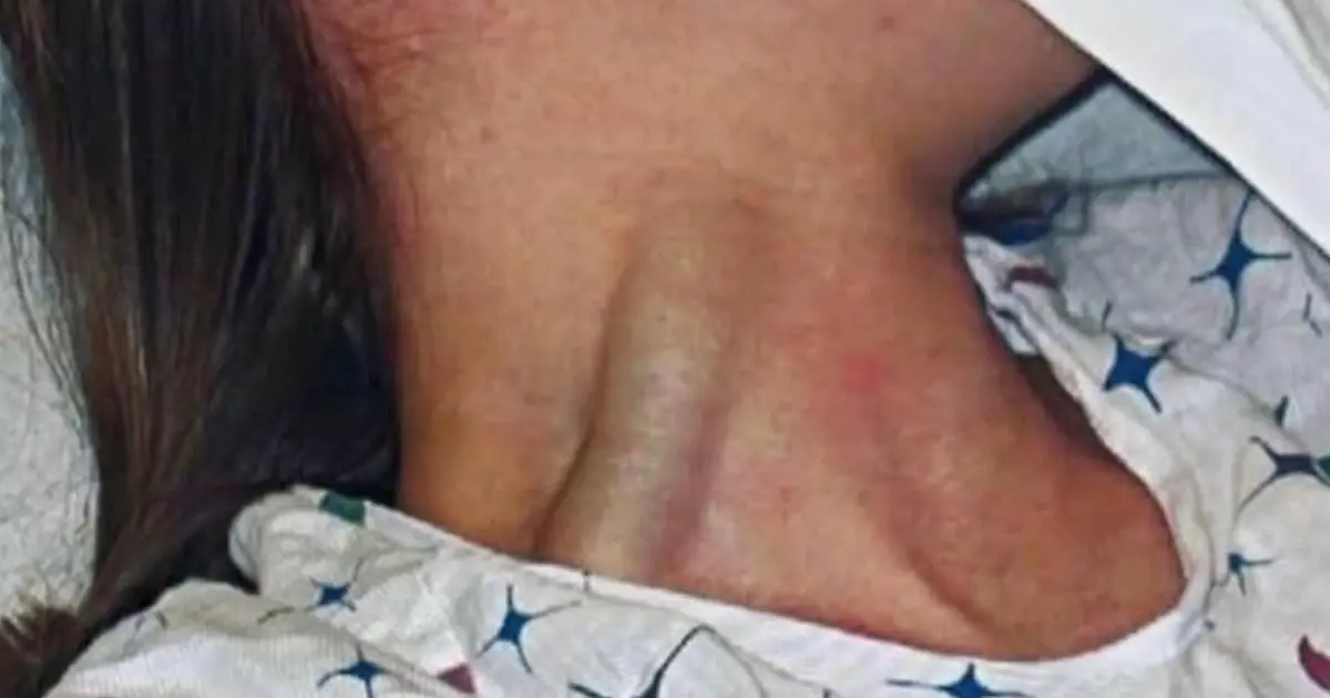 Massive jugular vein distension: a warning sign you shouldn’t ignore