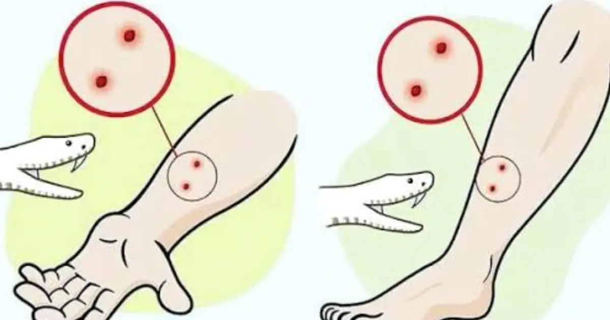 What You Should Do First If You’re Bitten by a Snake
