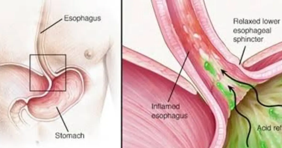 Your “Heartburn” May Be Trying to Tell You Something — 5 Signs to Know