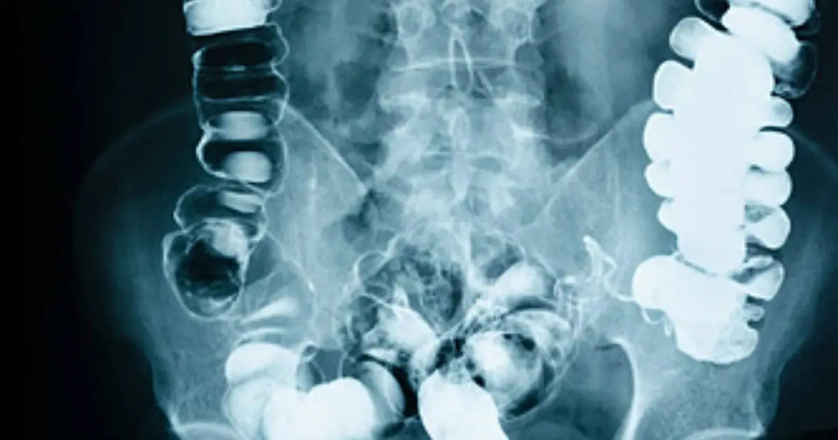 Months of Constipation Led Her to the Doctor — What the X-Ray Showed Was Unexpected