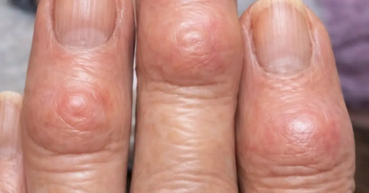 The Terrifying Truth Behind the Mysterious Hard Bumps Spreading Across Your Hands