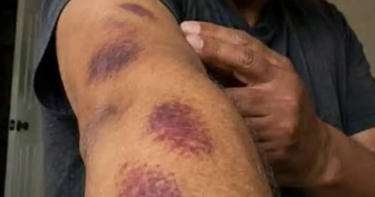 Bruising Easily? Your Body May Be Sending You a Warning Signal