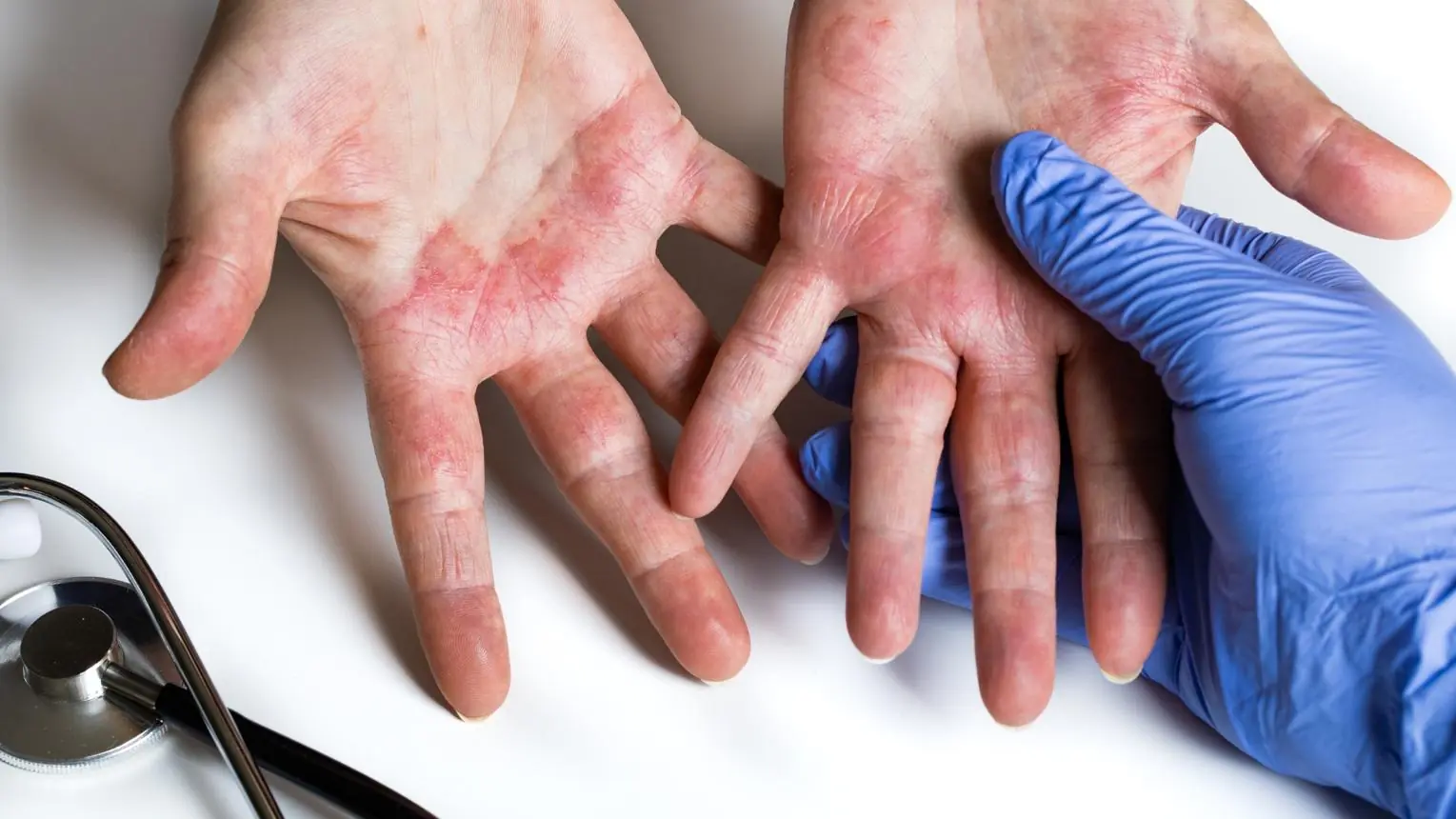 If You Have These Painful Red Bumps on Your Hands, Here’s What They Could Mean