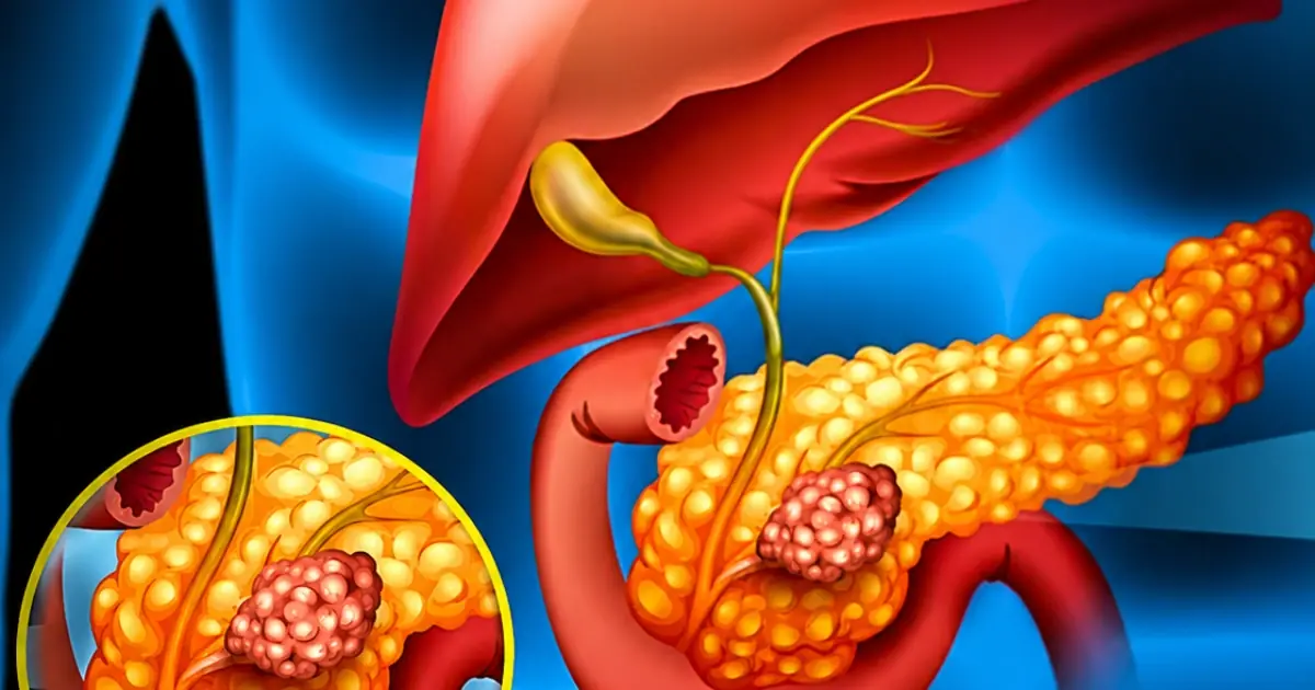 Signs of Pancreatic Can.cer You Should Never Ignore