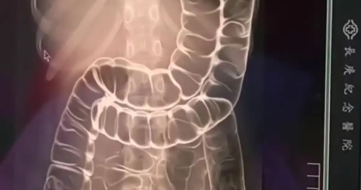 Chronic Constipation: A Hidden Threat to Your Digestive Health
