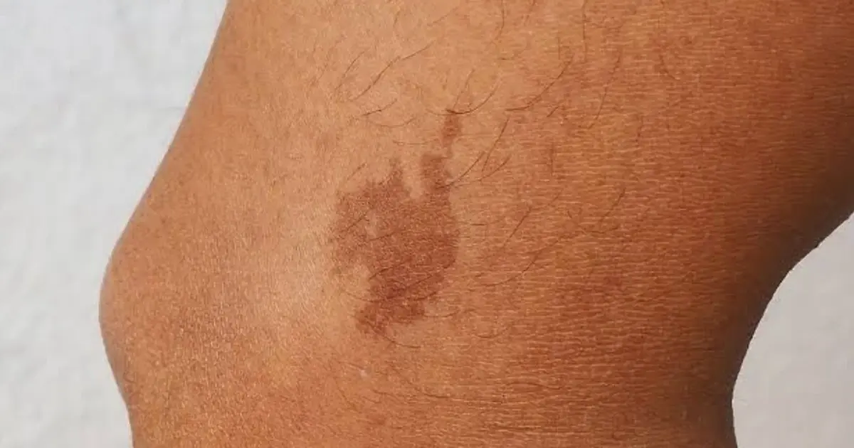 Dark Skin Patches Explained: Understanding Acanthosis Nigricans and When to See a Doctor