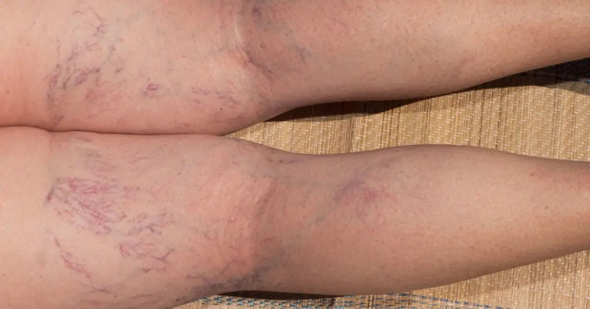 What Purple Veins on Your Legs May Tell You About Your Health?