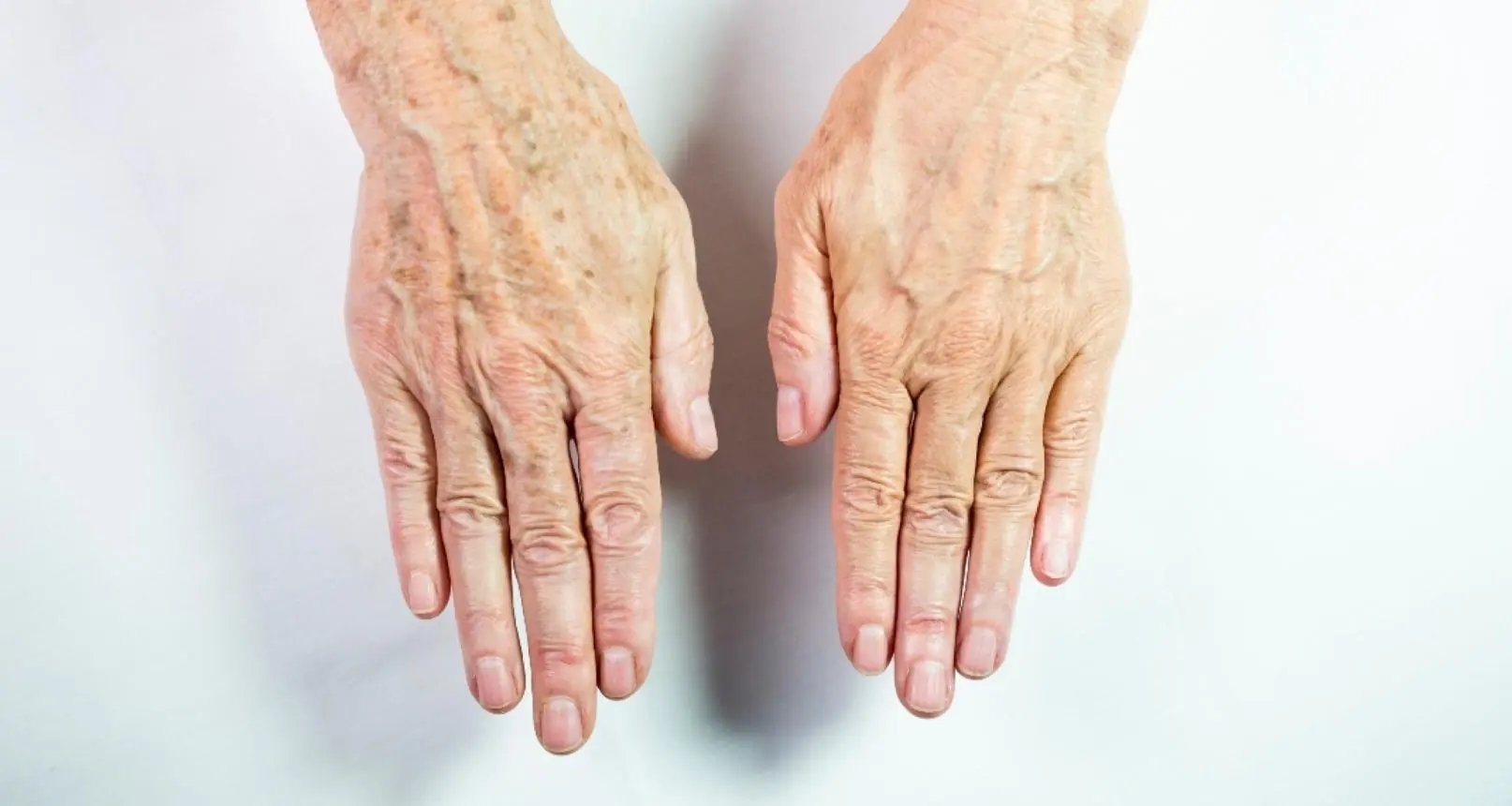 Visible Veins on Your Hands? Here’s What Your Body May Be Trying to Tell You