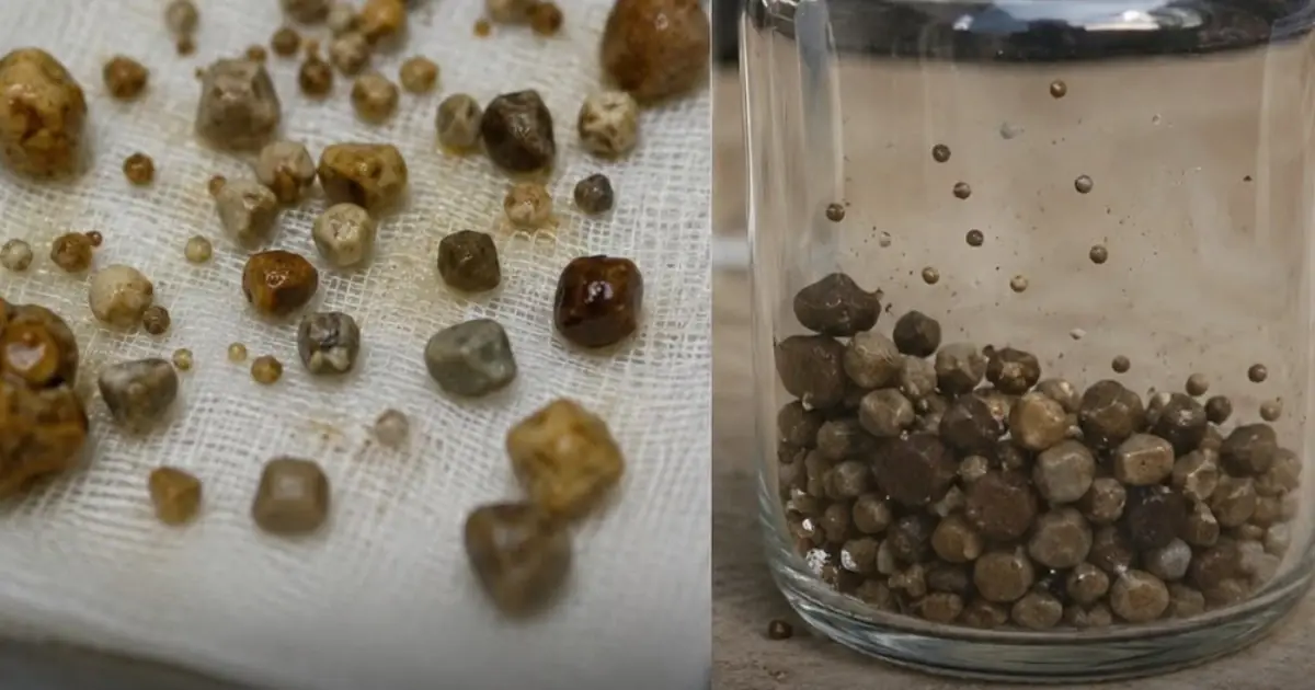 A 9-Year-Old Boy’s Mysterious Stones: Why Children’s Daily Habits Matter for Kidney and Urinary Health