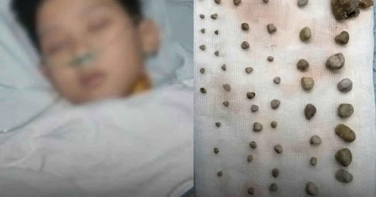 9-Year-Old Boy Found With 56 Stones in His Abdomen — Doctor Reveals the Cause, Mother Breaks Down