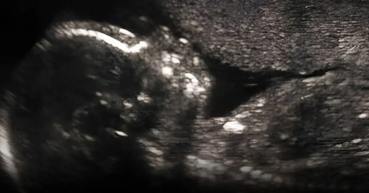 Scientists May Have Found a Clue to One Cause of Autism, Sparking New Research