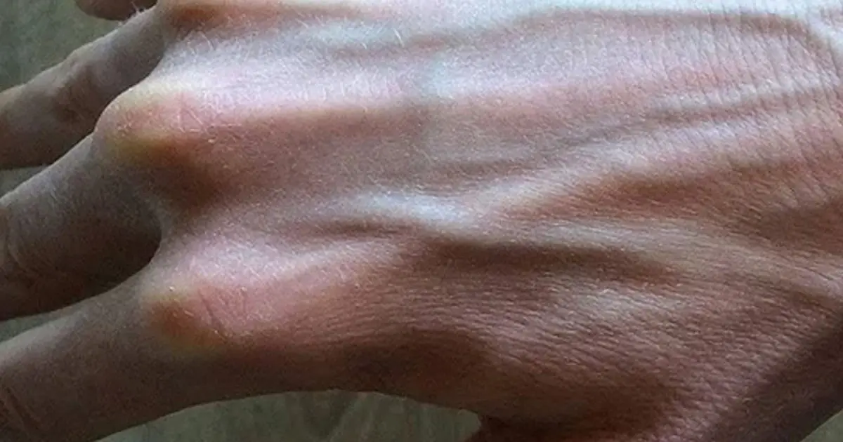 Visible Veins on Your Hands: A Normal Sign of Aging or a Health Warning?