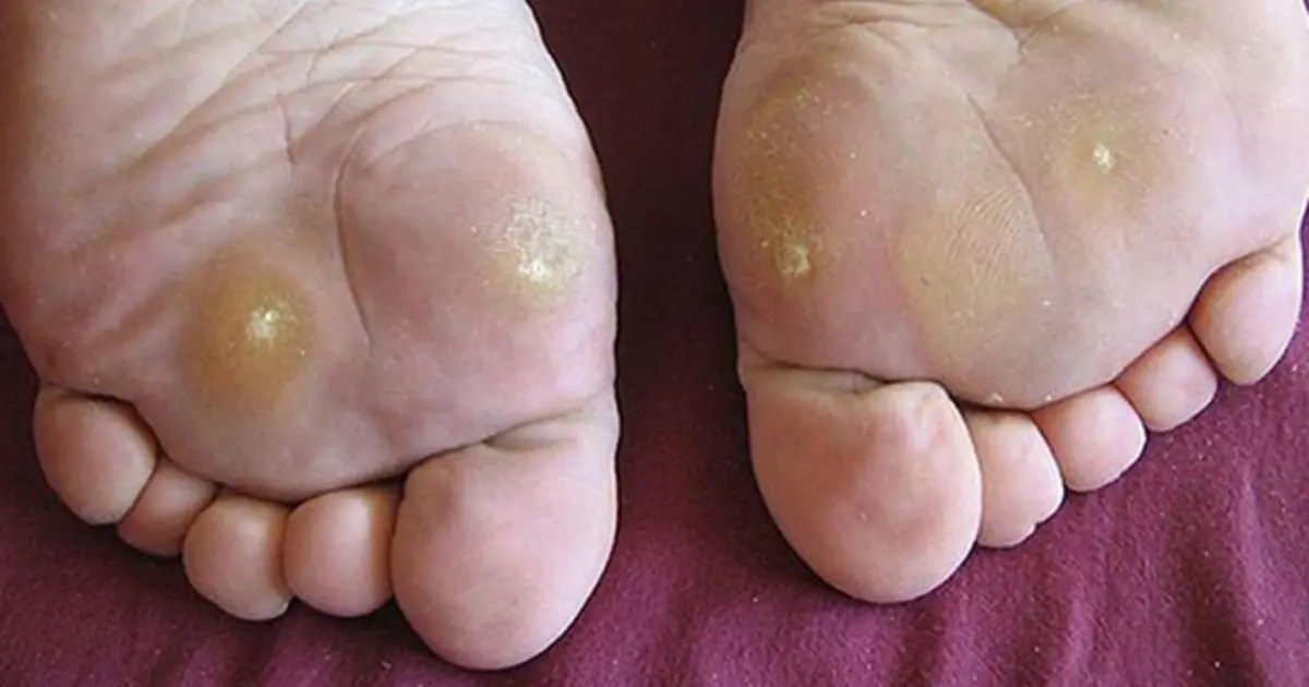 15 Changes in Your Feet You Shouldn’t Ignore if You Have Diabetes
