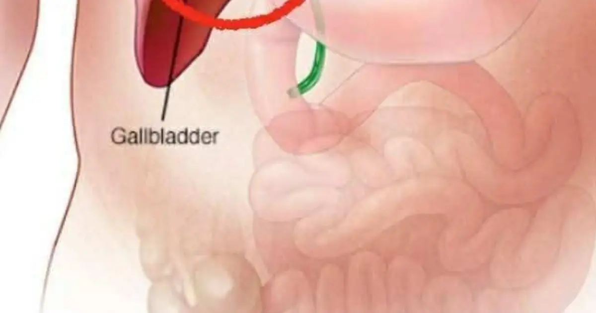 What Really Happens After Gallbladder Removal? Understanding the Risks and the Reality