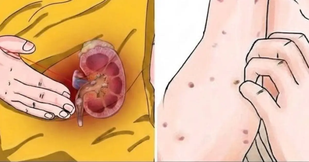 How to Spot Early Signs of Kidney Disease and Support Healthy Kidneys
