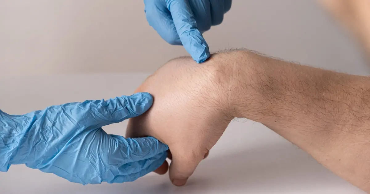 Found a Lump on Your Hand? Here’s What It Could Mean