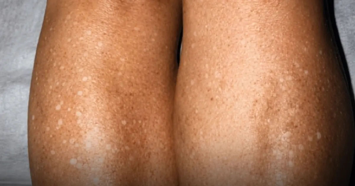 If you have small white spots on your arms or legs, it’s a clear sign that…See more