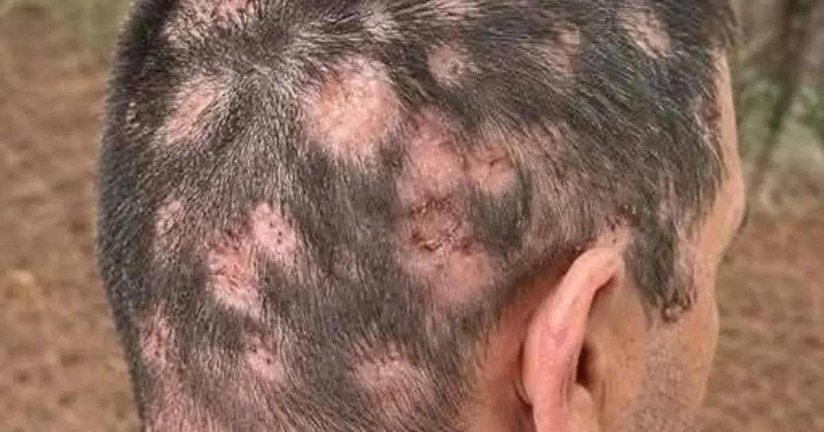 Here Are the First Symptoms After Contact With: Recognizing Early Warning Signs