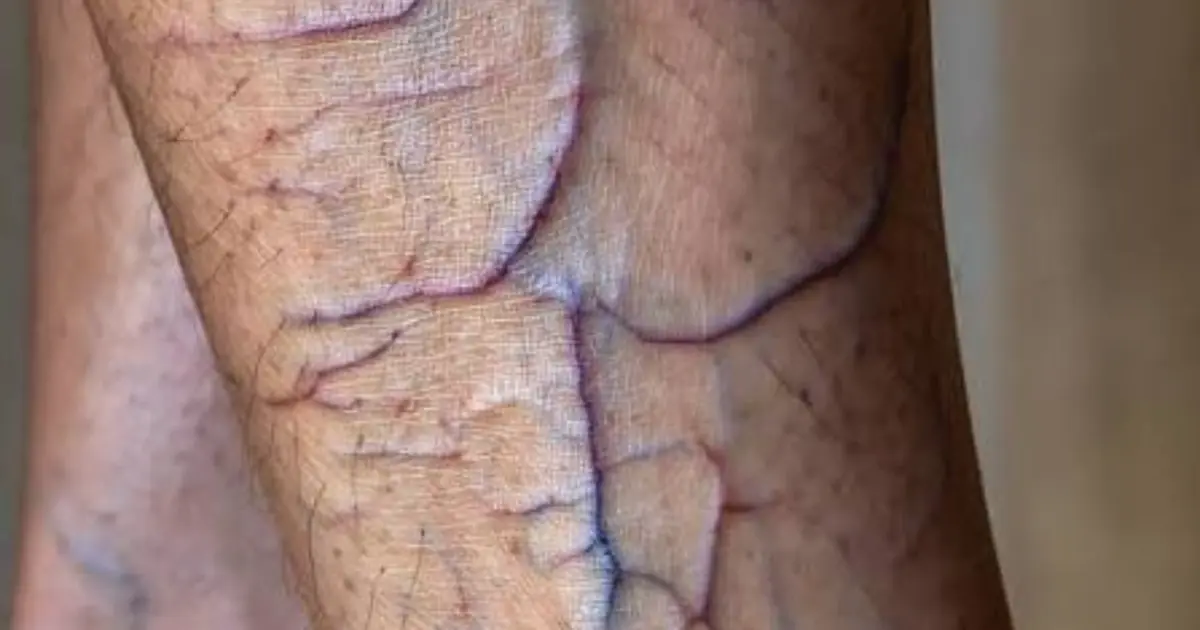 Why Are the Veins on Your Legs Turning Purple?  The reason may surprise you…