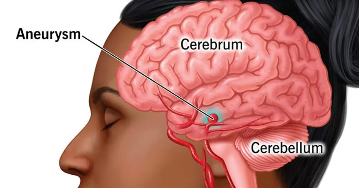 Could Your Body Be Warning You About an Aneurysm?