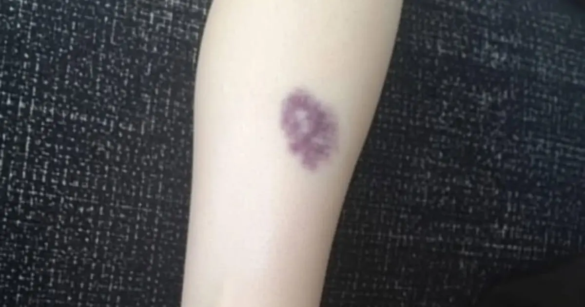 BE CAREFUL, if you get these bruises on your body, it means you have Ca…see more