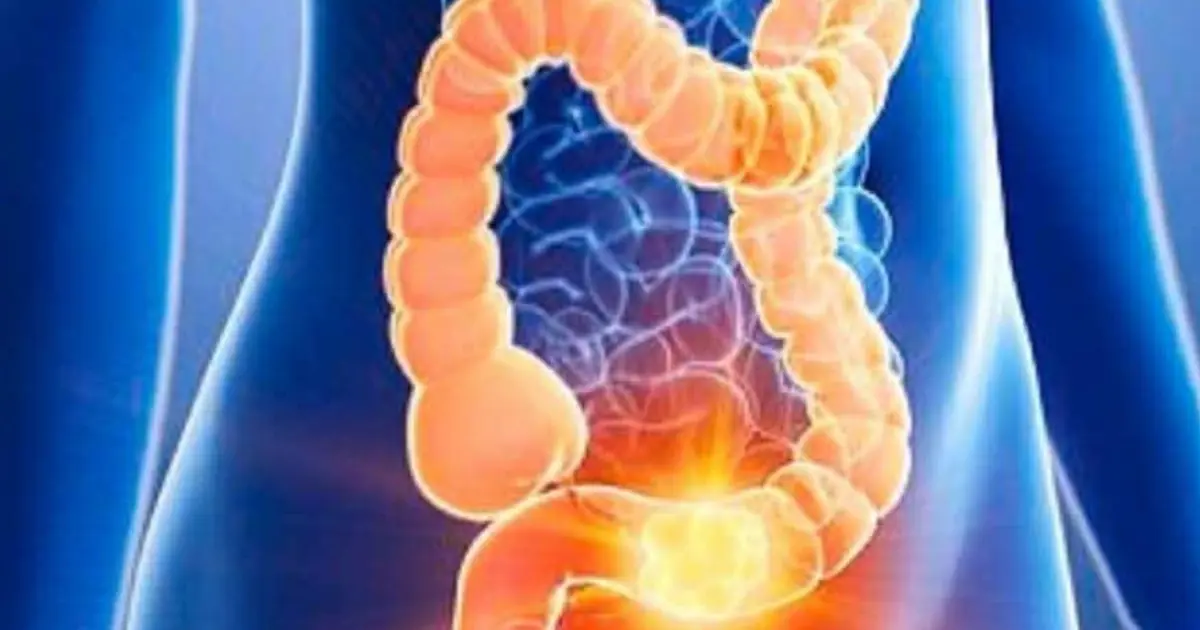 The 5 Warning Signs She Ignored: A Woman’s Battle With Stage IV Colon Cancer