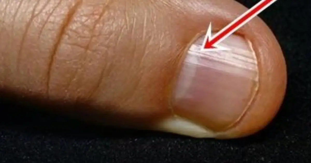 Your Nails Could Be Sending Warning Signs — Especially After 40