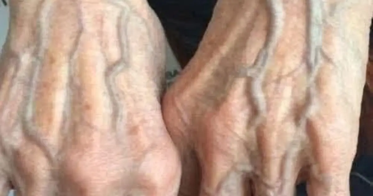If your veins are visible in your hand, it is a signal of ca… See more