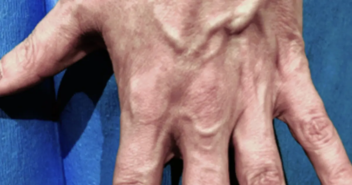 Visible Hand Veins: When Is It Normal—and When Should You Pay Attention?
