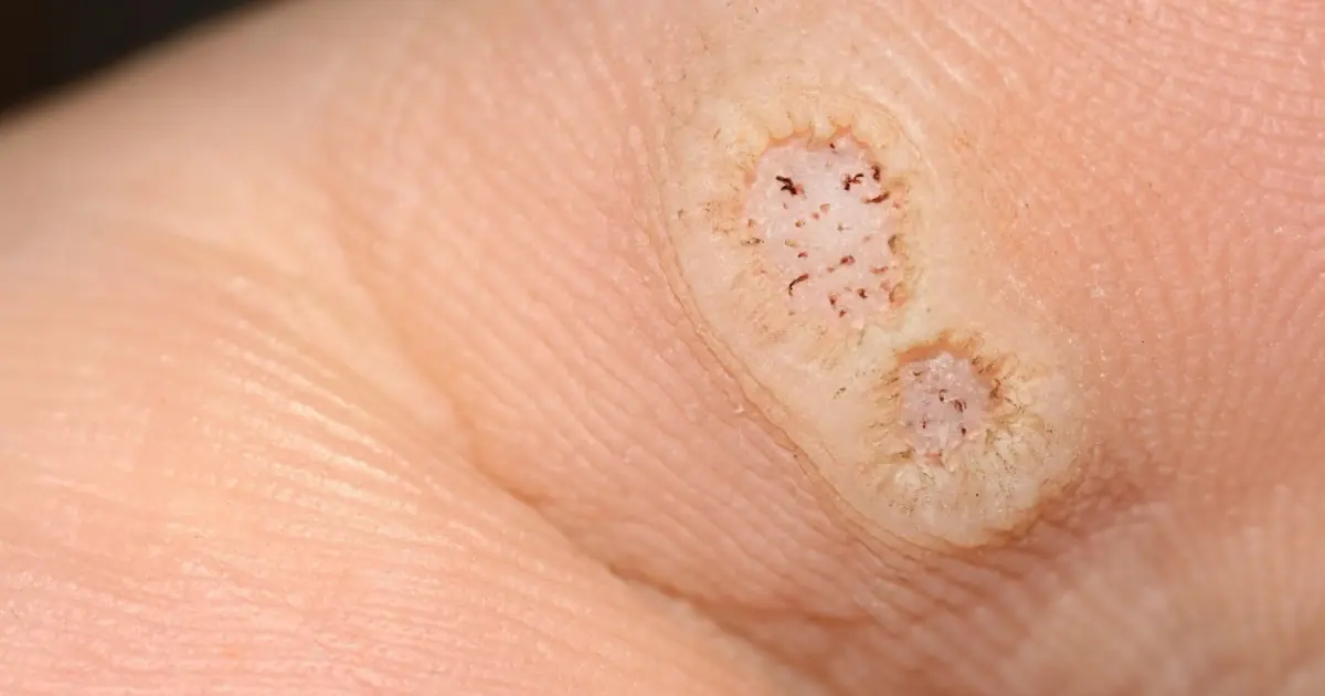 6 Different Types of Warts—How to Tell Them Apart and When to Seek Treatment