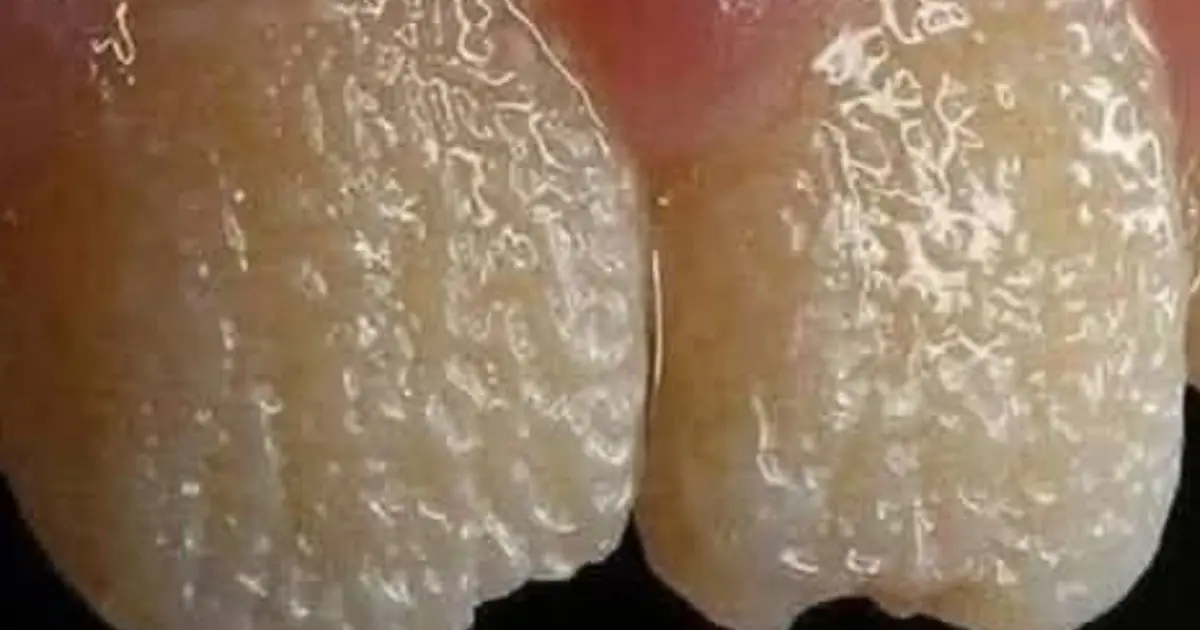 Be careful!! This is what your teeth will become when you eat...see more