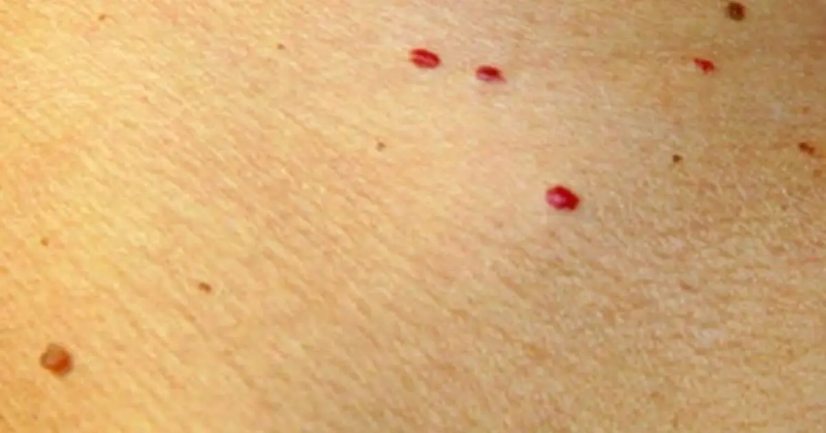 What Those Tiny Red Dots on Your Skin Could Mean, According to Experts