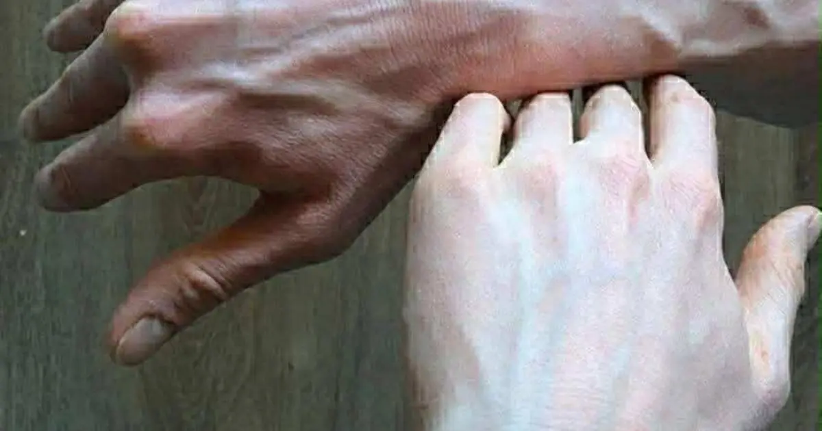 If You Notice Bulging Veins, Here’s What Your Body Might Be Trying to Tell You