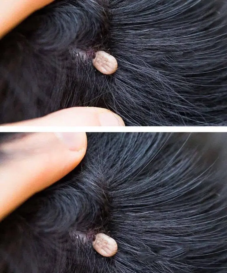 Strange Bump Found in a Child’s Hair? Here’s What Parents Should Know