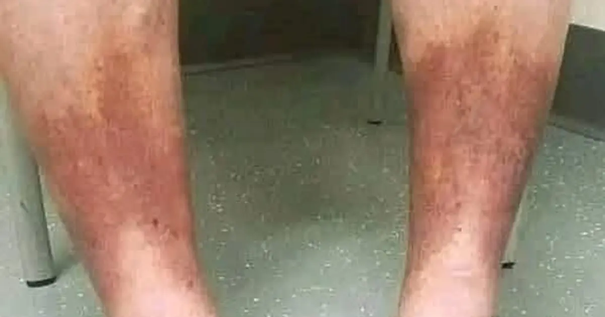 Swollen Feet and Ankles: 10 Possible Causes, Warning Signs, and When to See a Doctor