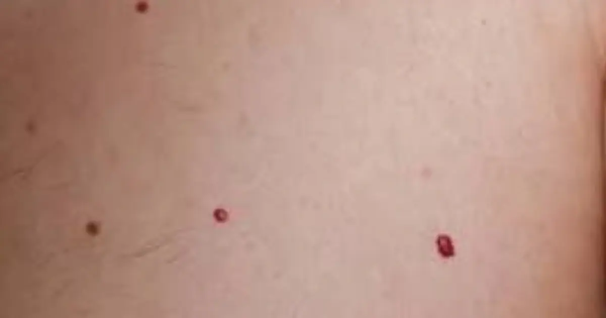 Tiny Red Dots on Your Skin? Here’s What Your Body Could Be Signaling