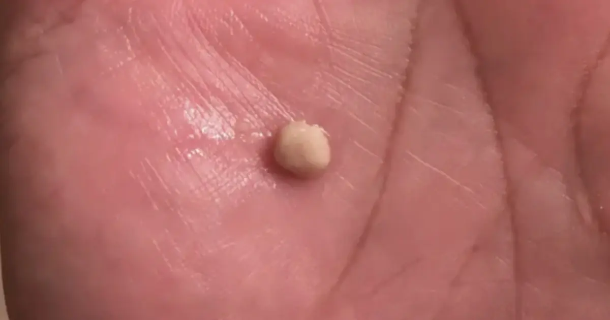 Here's What You Need to Know About Tonsil Stones: Causes, Symptoms, and Prevention