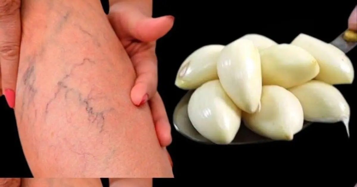 Leg pain, rheumatism, varicose veins, arthritis, headache, joint pain
