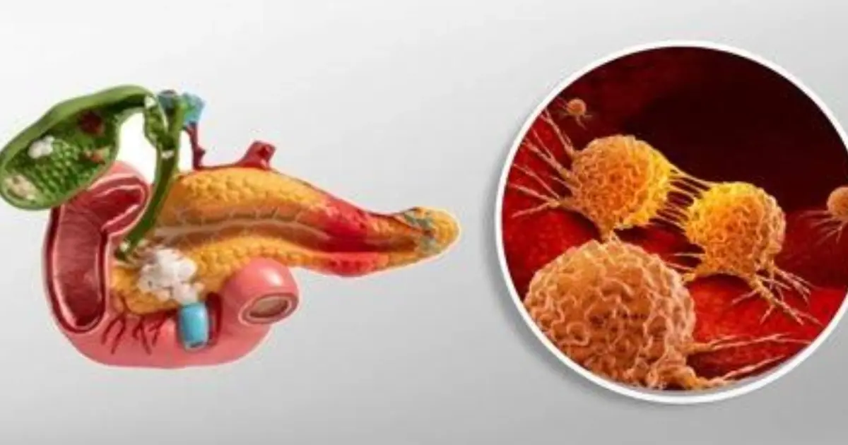 Pancreatic cancer may cause subtle symptoms that are easy to mistake for everyday health problems.