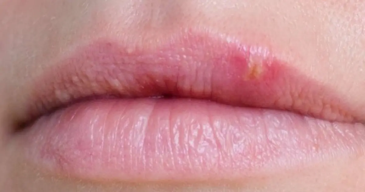 Noticed White Spots on Your Lips or Intimate Area? Here’s What They Could Mean
