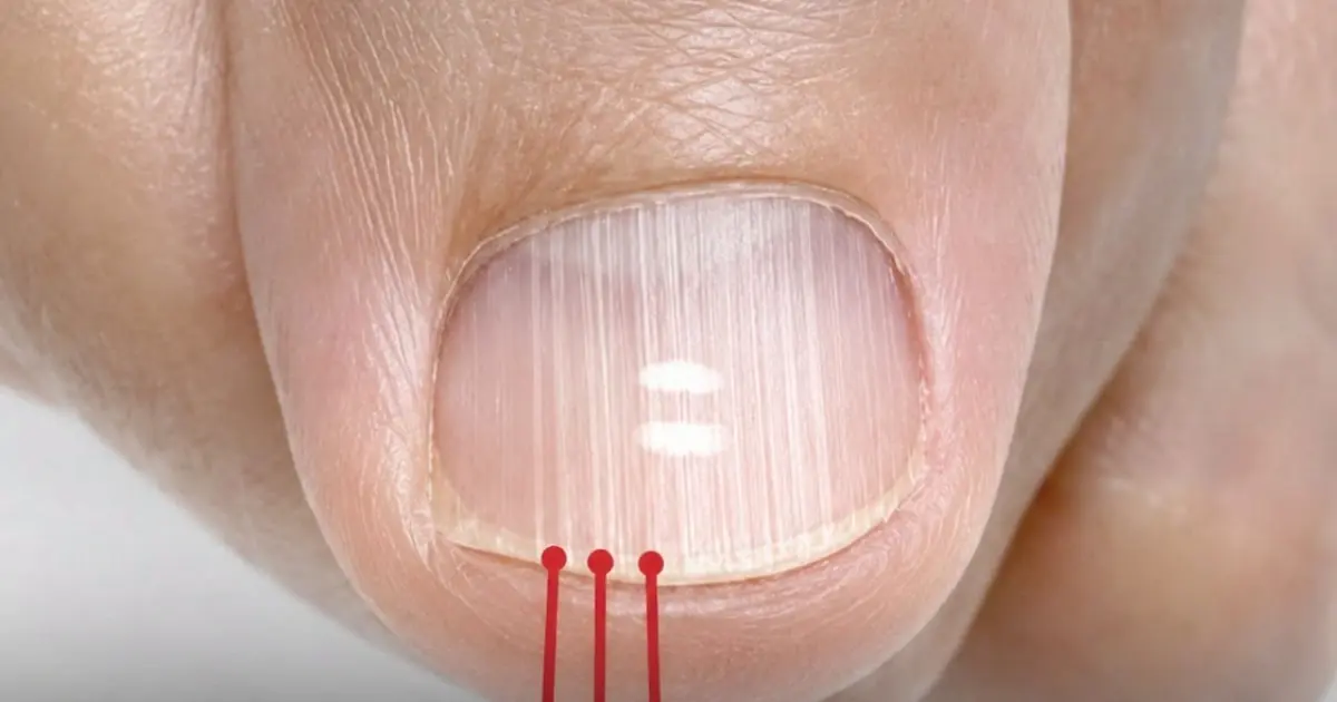 If you have these lines on your nails after 40, it is a clear sign that..