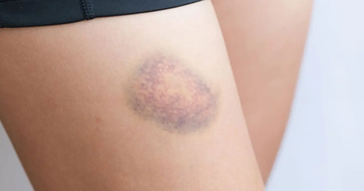 Bruising for No Apparent Reason? What Your Body May Be Telling You