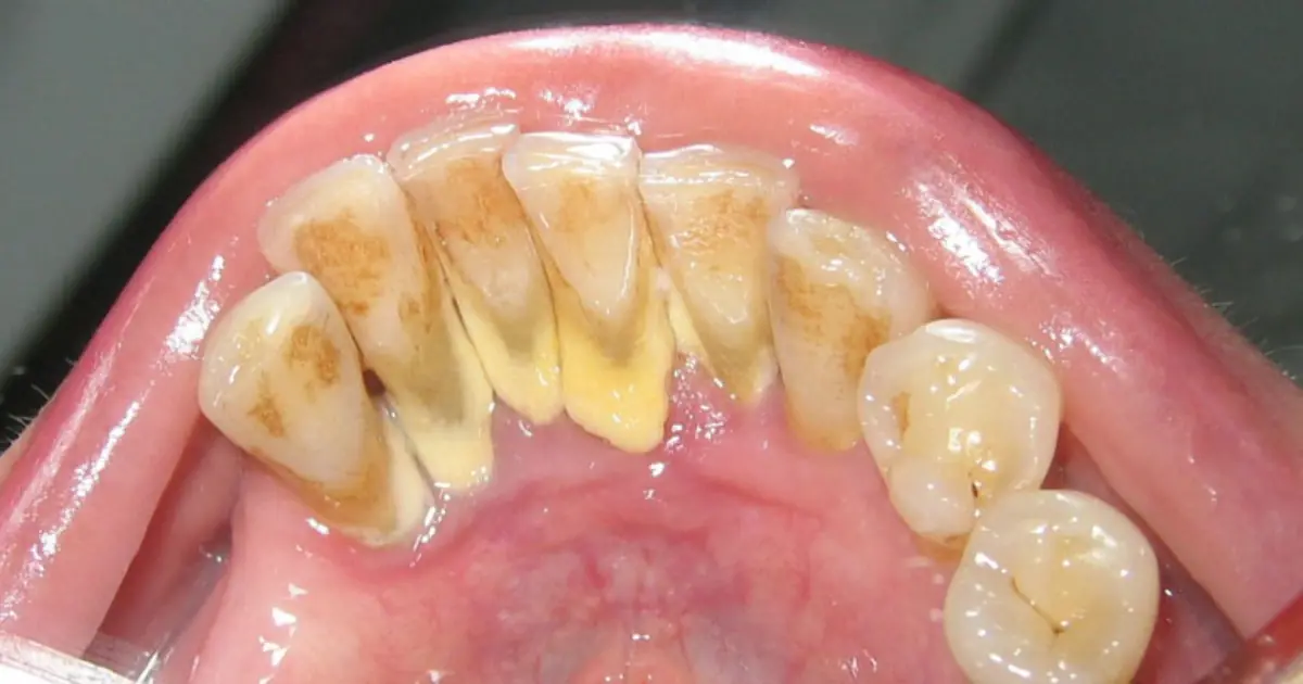 How to Get Rid of Dental Plaque Naturally: What Actually Works