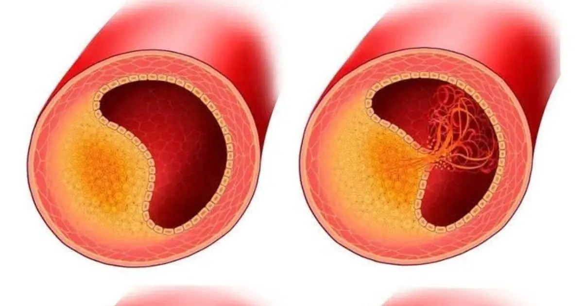 Can You Really “Clean Your Arteries”? What Science Actually Says